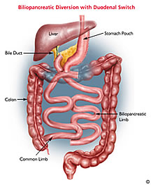 Duodenal Switch 