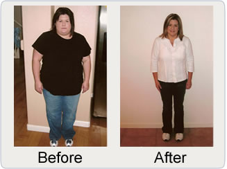 gastric bypass before and after