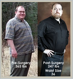 gastric bypass before and after skin